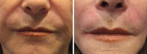 Juvederm Before and After Nasolabial Folds