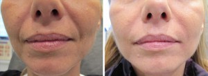 Juvederm Nasolabial Folds Before and After