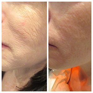 PRP TREATMENT FOR FACE